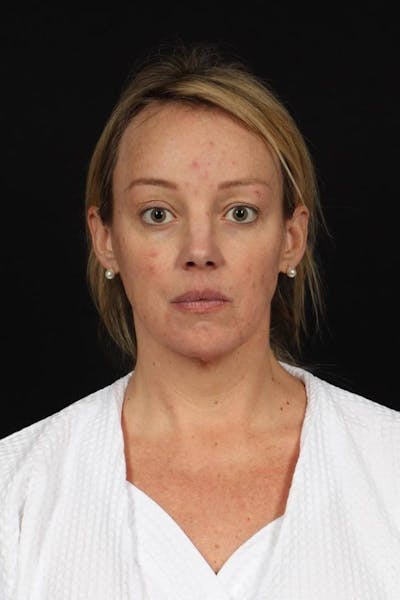 Facelift Before & After Gallery - Patient 184049 - Image 1