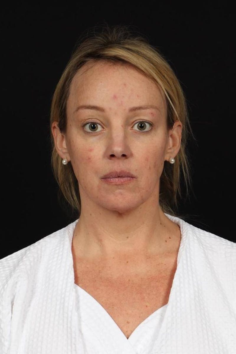 Facelift Before & After Gallery - Patient 184049 - Image 1