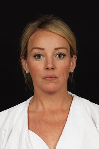 Facelift Before & After Gallery - Patient 184049 - Image 2