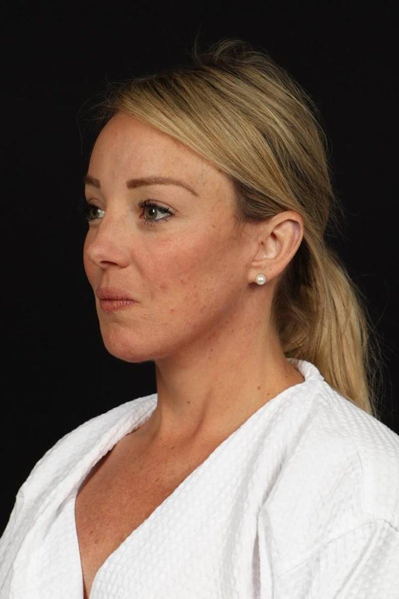 Facelift Before & After Gallery - Patient 184049 - Image 4