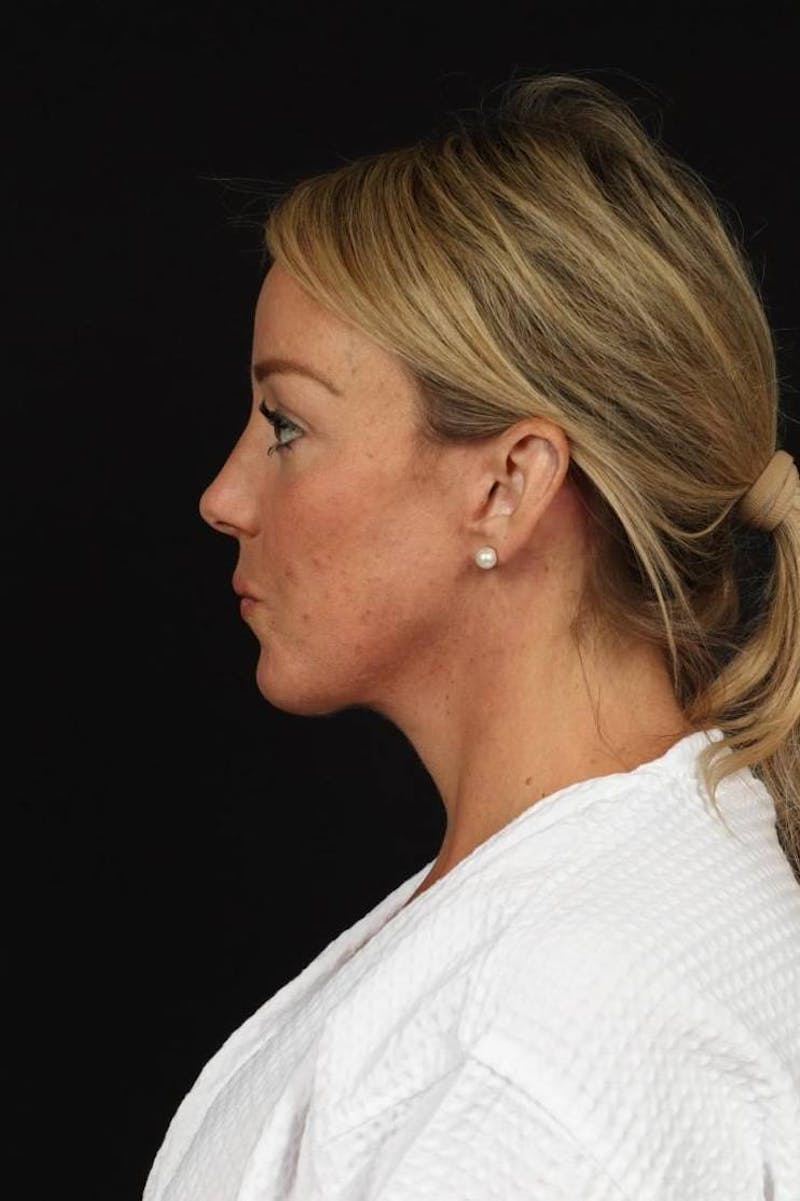 Facelift Before & After Gallery - Patient 184049 - Image 6