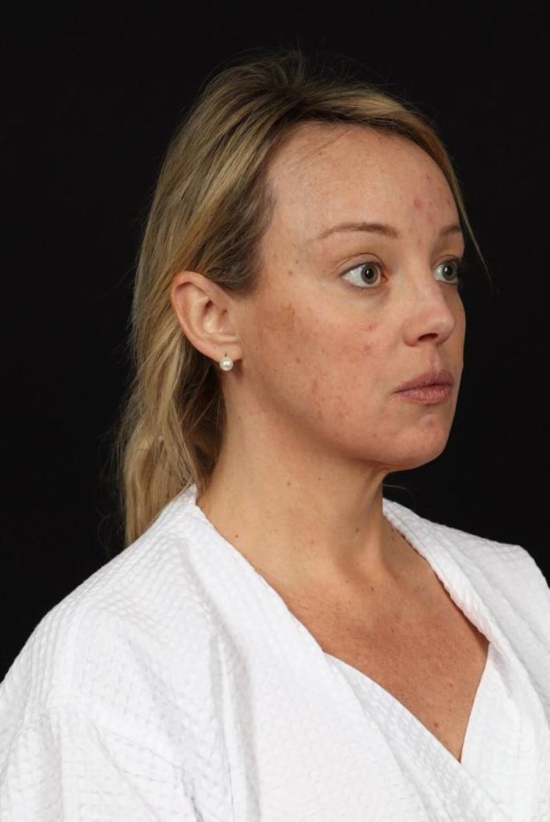 Facelift Before & After Gallery - Patient 184049 - Image 7
