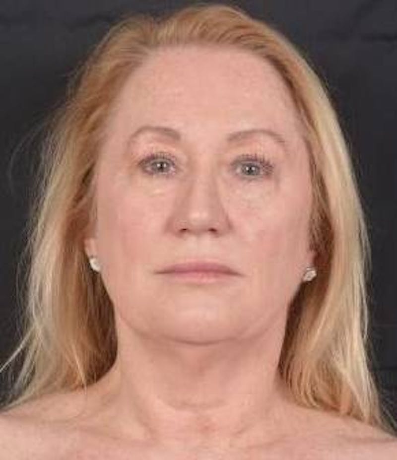 Facelift Before & After Gallery - Patient 366547 - Image 1