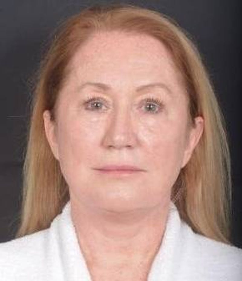 Facelift Before & After Gallery - Patient 366547 - Image 2