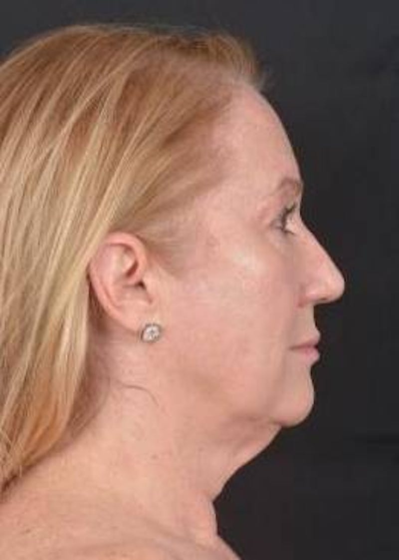 Facelift Before & After Gallery - Patient 366547 - Image 5