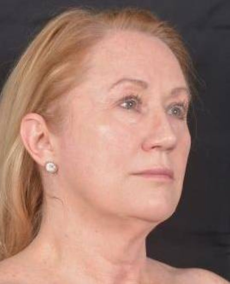 Facelift Before & After Gallery - Patient 366547 - Image 9