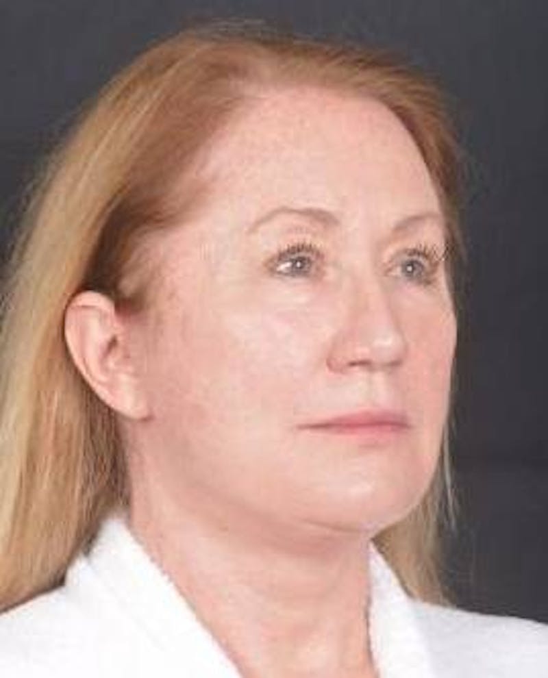 Facelift Before & After Gallery - Patient 366547 - Image 10
