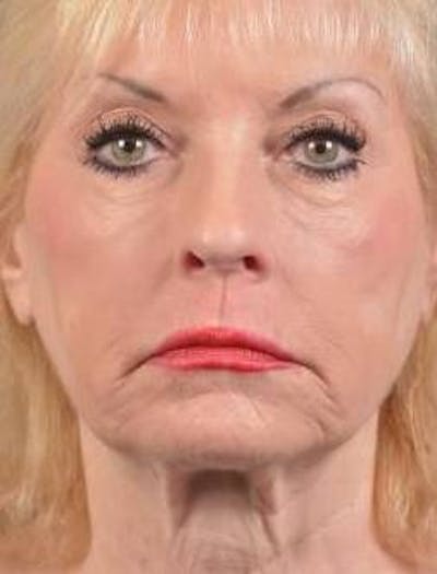 Facelift Before & After Gallery - Patient 159397 - Image 1