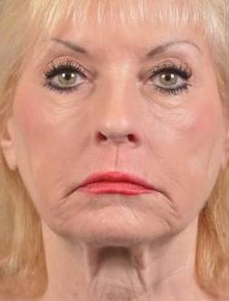 Facelift Before & After Gallery - Patient 159397 - Image 1