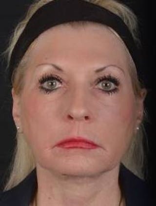 Facelift Before & After Gallery - Patient 159397 - Image 2