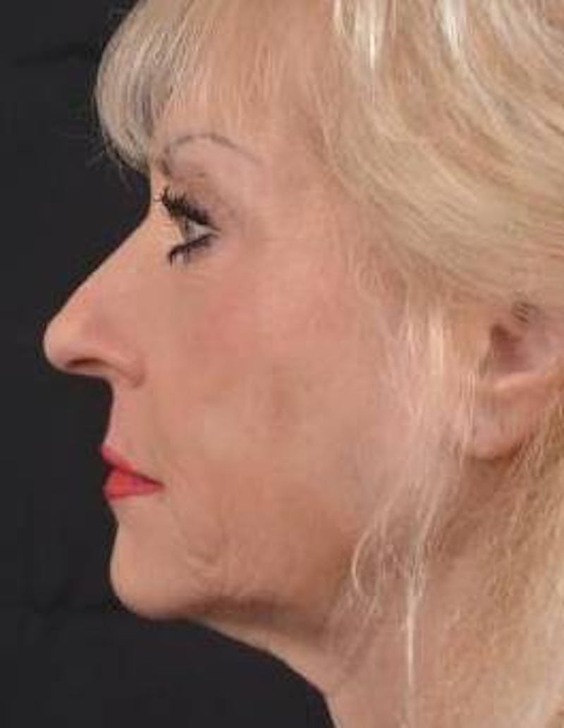 Facelift Before & After Gallery - Patient 159397 - Image 3