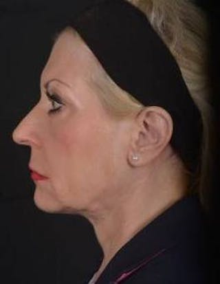 Facelift Before & After Gallery - Patient 159397 - Image 4