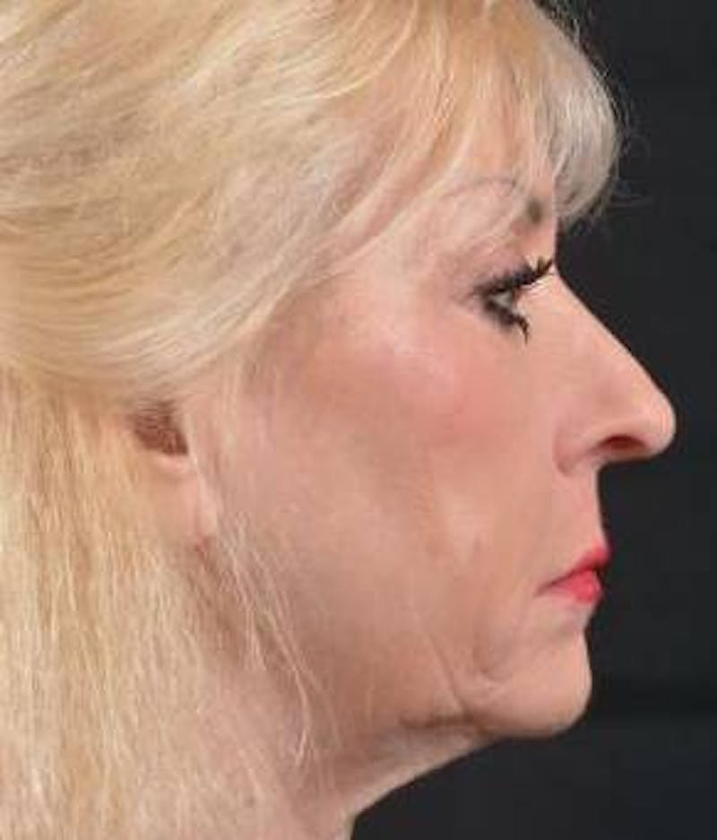 Facelift Before & After Gallery - Patient 159397 - Image 5