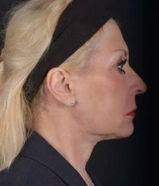 Facelift Before & After Gallery - Patient 159397 - Image 6