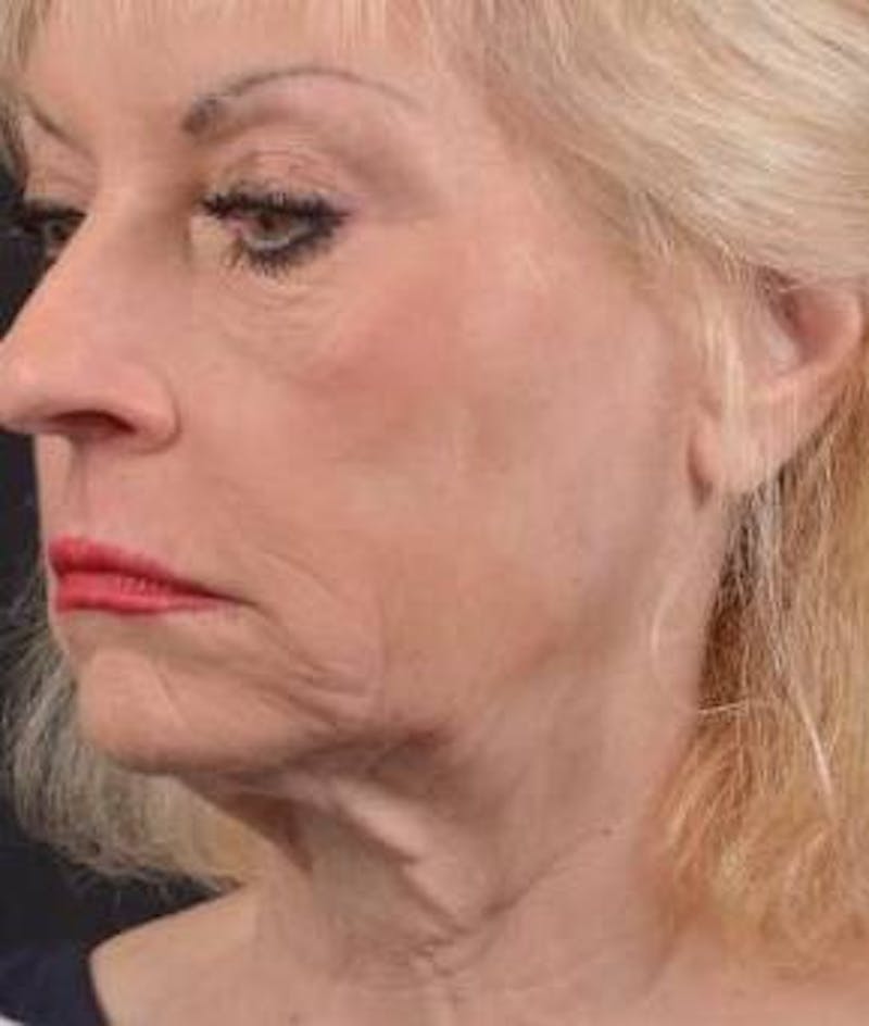 Facelift Before & After Gallery - Patient 159397 - Image 7