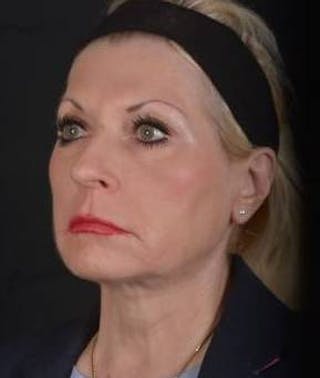 Facelift Before & After Gallery - Patient 159397 - Image 8