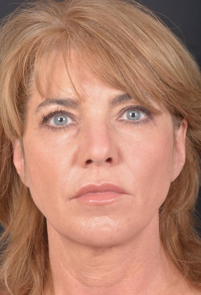 Facelift Before & After Gallery - Patient 753205 - Image 1