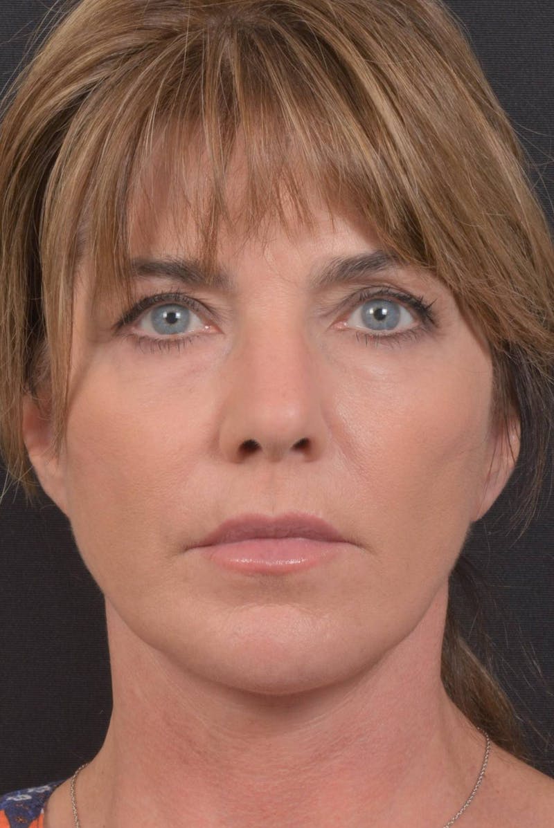 Facelift Before & After Gallery - Patient 753205 - Image 2