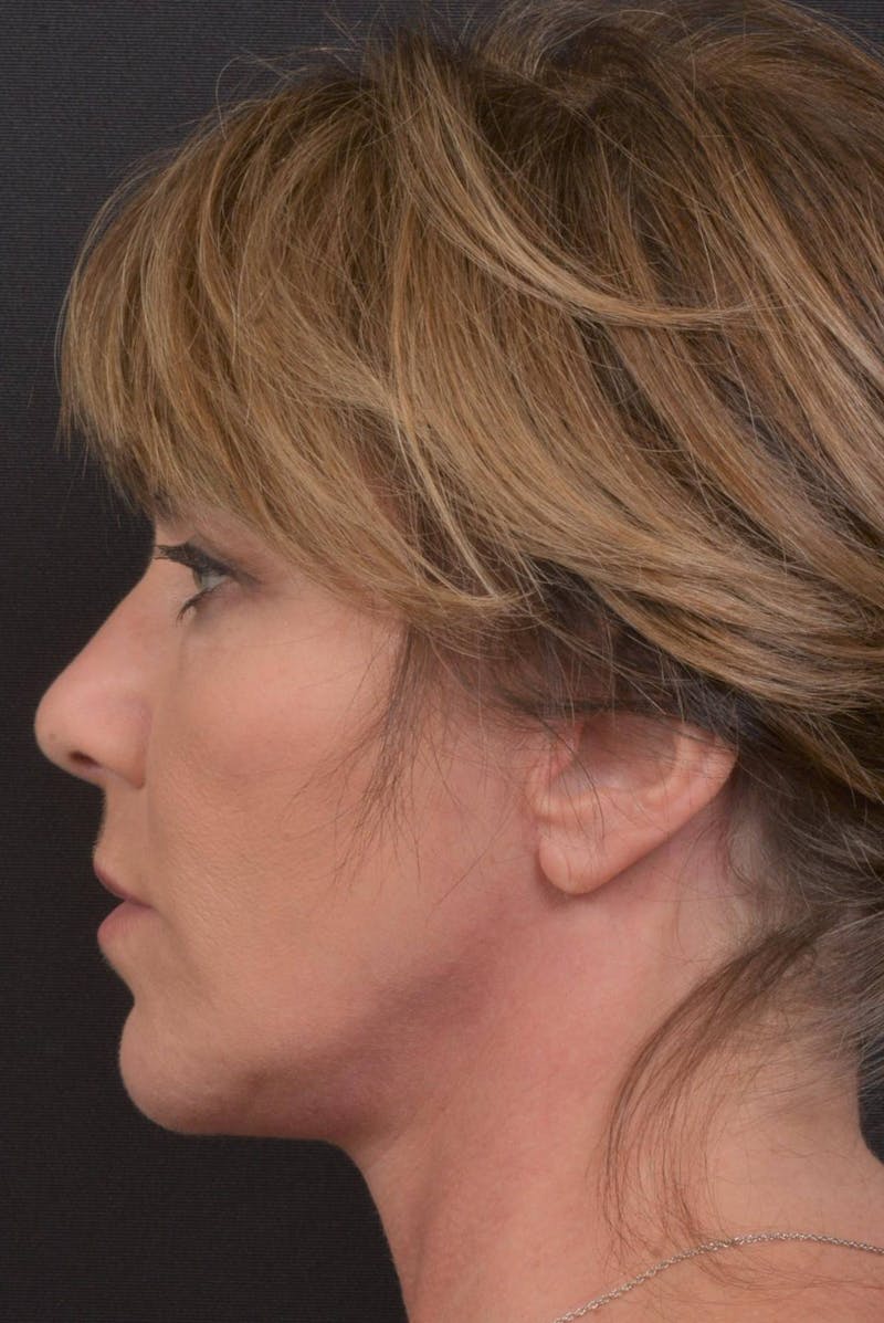 Facelift Before & After Gallery - Patient 753205 - Image 4