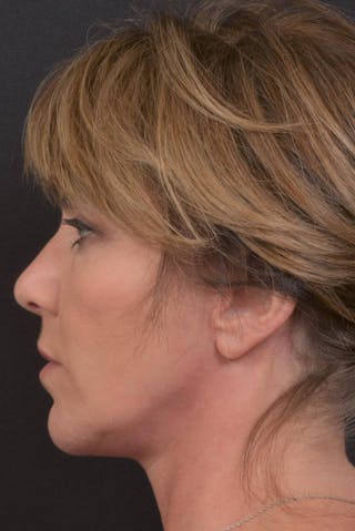 Facelift Before & After Gallery - Patient 753205 - Image 4