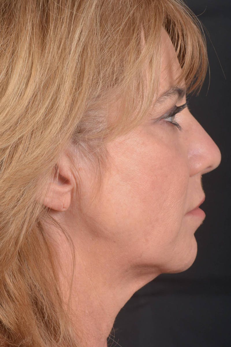 Facelift Before & After Gallery - Patient 753205 - Image 5