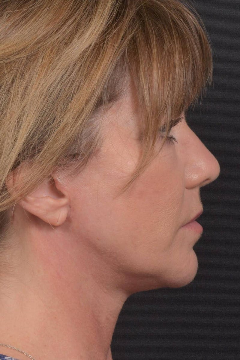 Facelift Before & After Gallery - Patient 753205 - Image 6