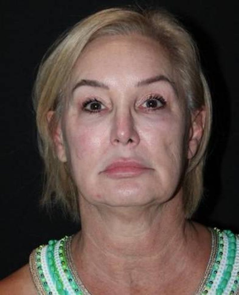 Facelift Before & After Gallery - Patient 298697 - Image 1