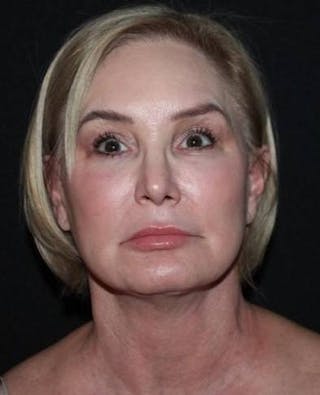 Facelift Before & After Gallery - Patient 298697 - Image 2