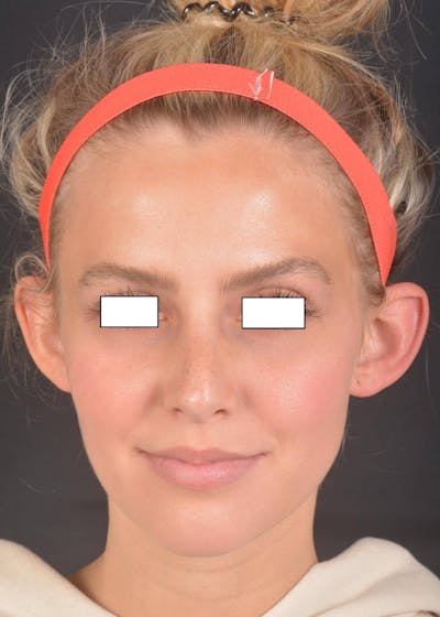 Otoplasty Before & After Gallery - Patient 300954 - Image 1