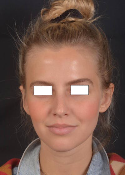 Otoplasty Before & After Gallery - Patient 300954 - Image 2