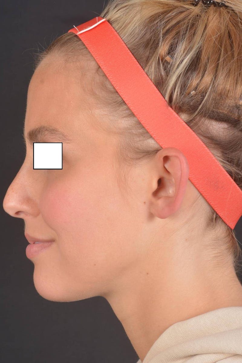 Otoplasty Before & After Gallery - Patient 300954 - Image 3