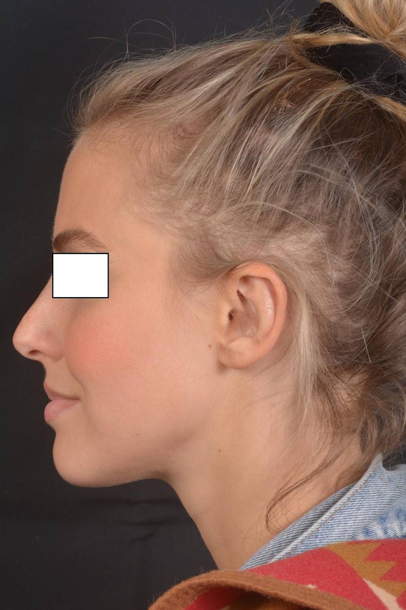 Otoplasty Before & After Gallery - Patient 300954 - Image 4
