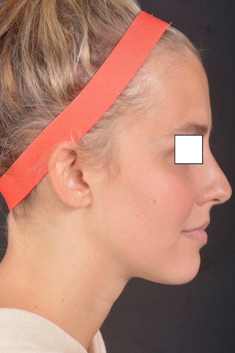 Otoplasty Before & After Gallery - Patient 300954 - Image 5