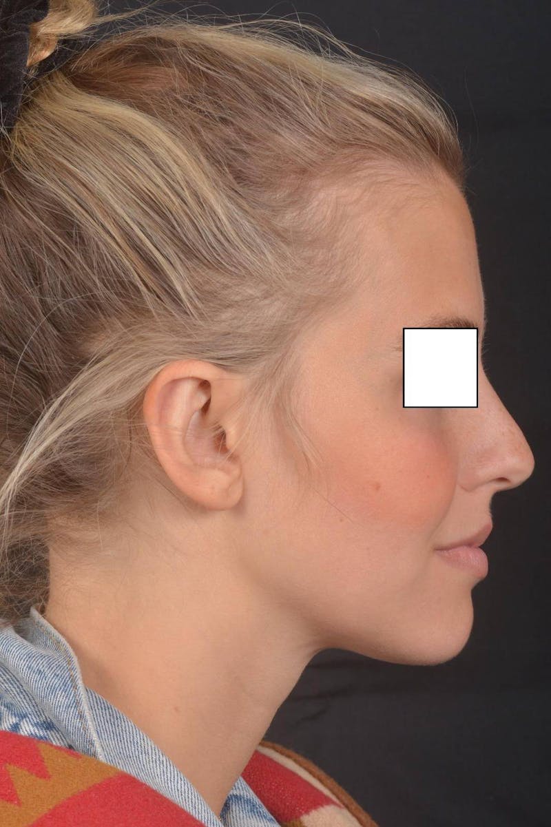 Otoplasty Before & After Gallery - Patient 300954 - Image 6