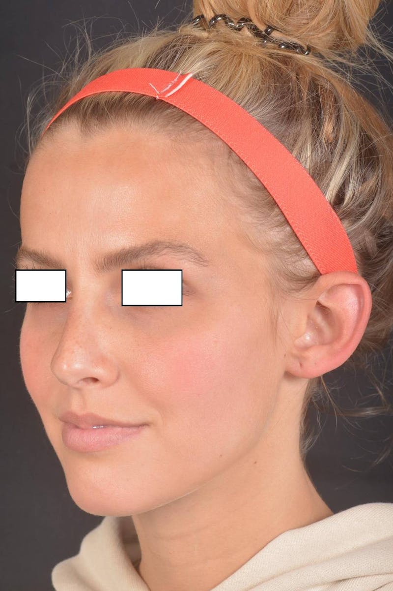 Otoplasty Before & After Gallery - Patient 300954 - Image 7