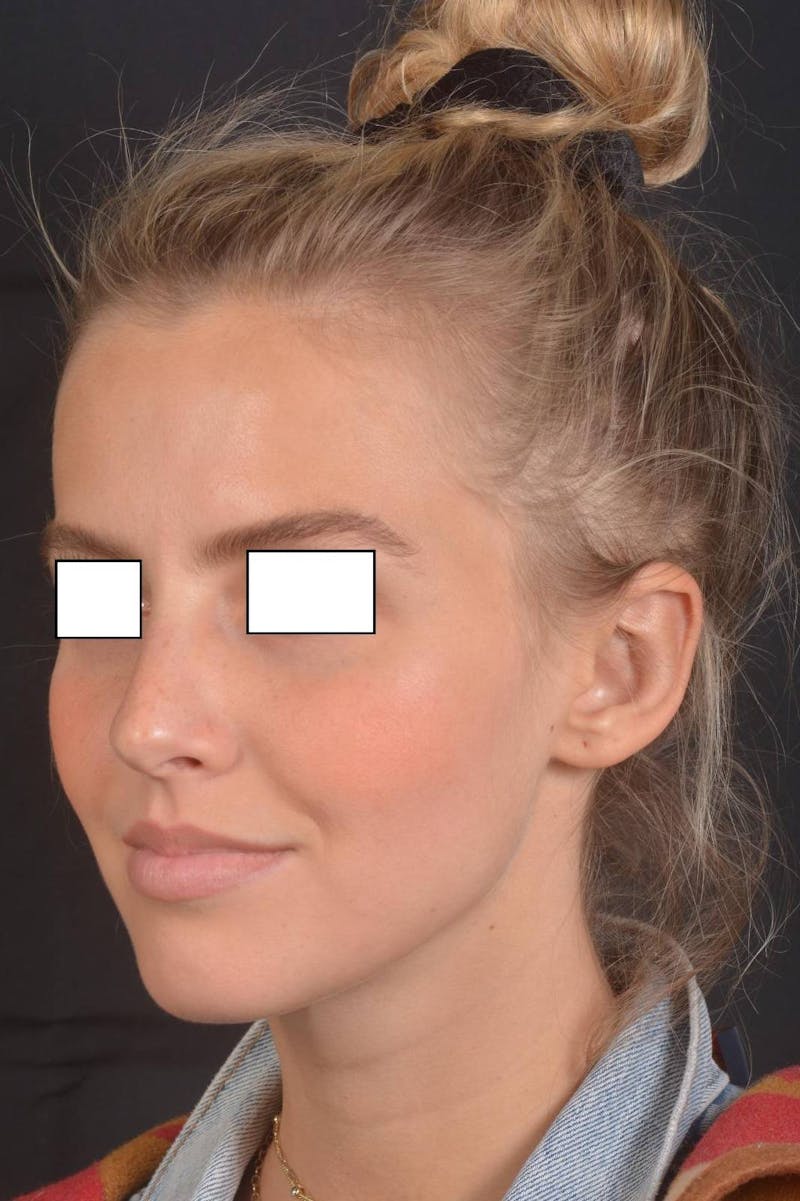Otoplasty Before & After Gallery - Patient 300954 - Image 8
