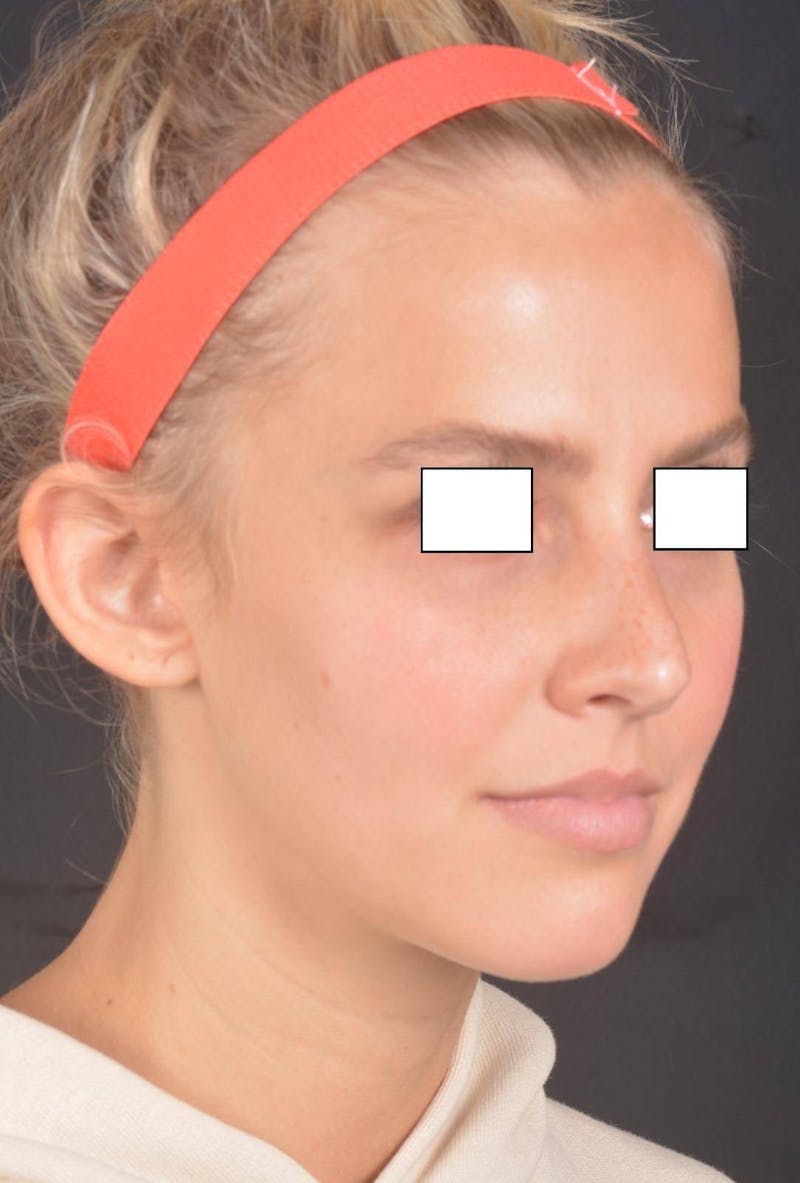 Otoplasty Before & After Gallery - Patient 300954 - Image 9