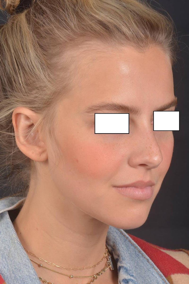 Otoplasty Before & After Gallery - Patient 300954 - Image 11