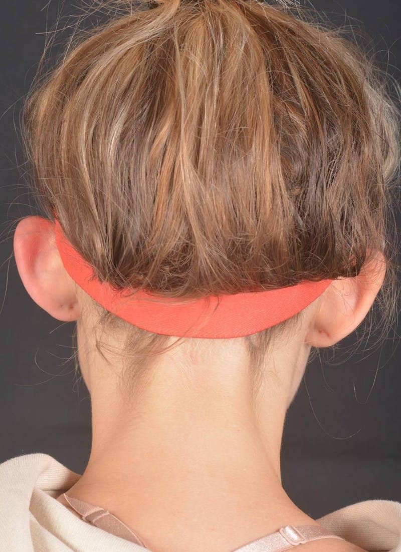 Otoplasty Before & After Gallery - Patient 300954 - Image 12