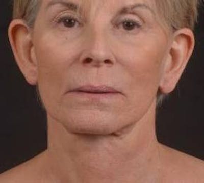 Otoplasty Before & After Gallery - Patient 202226 - Image 2