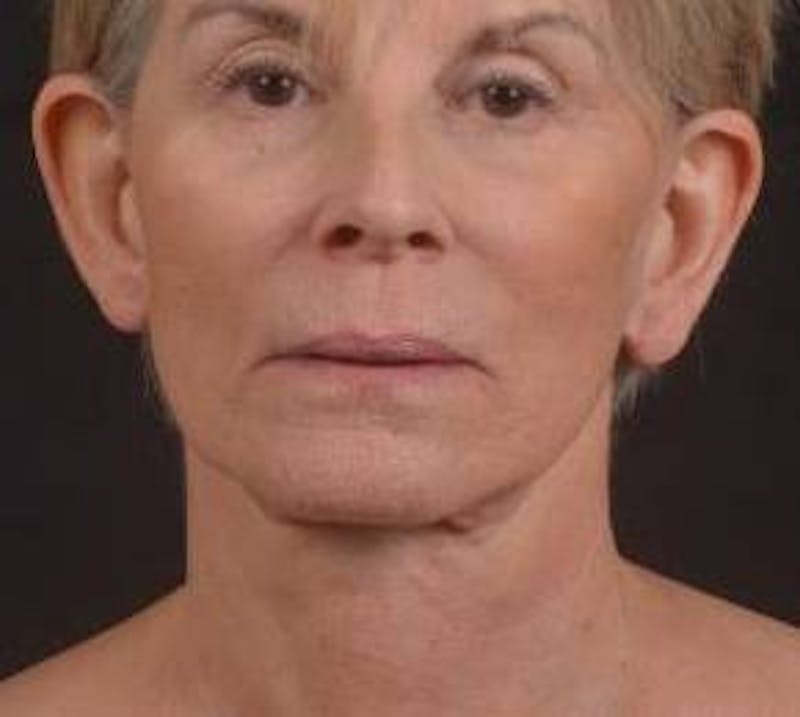 Otoplasty Before & After Gallery - Patient 202226 - Image 2