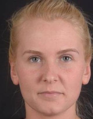 Otoplasty Before & After Gallery - Patient 335882 - Image 2