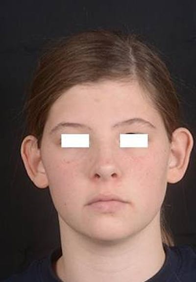 Otoplasty Before & After Gallery - Patient 179716 - Image 1