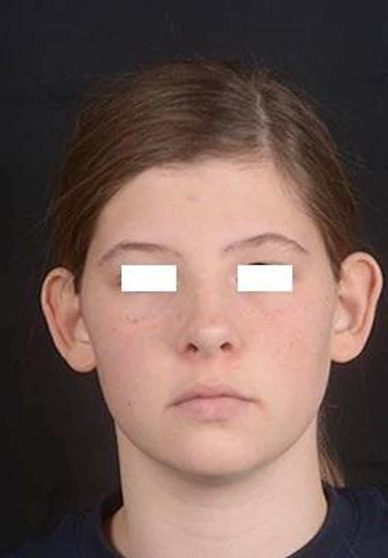 Otoplasty Before & After Gallery - Patient 179716 - Image 1