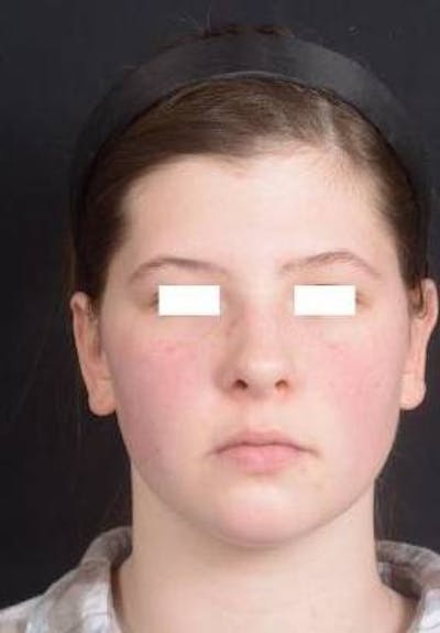 Otoplasty Before & After Gallery - Patient 179716 - Image 2
