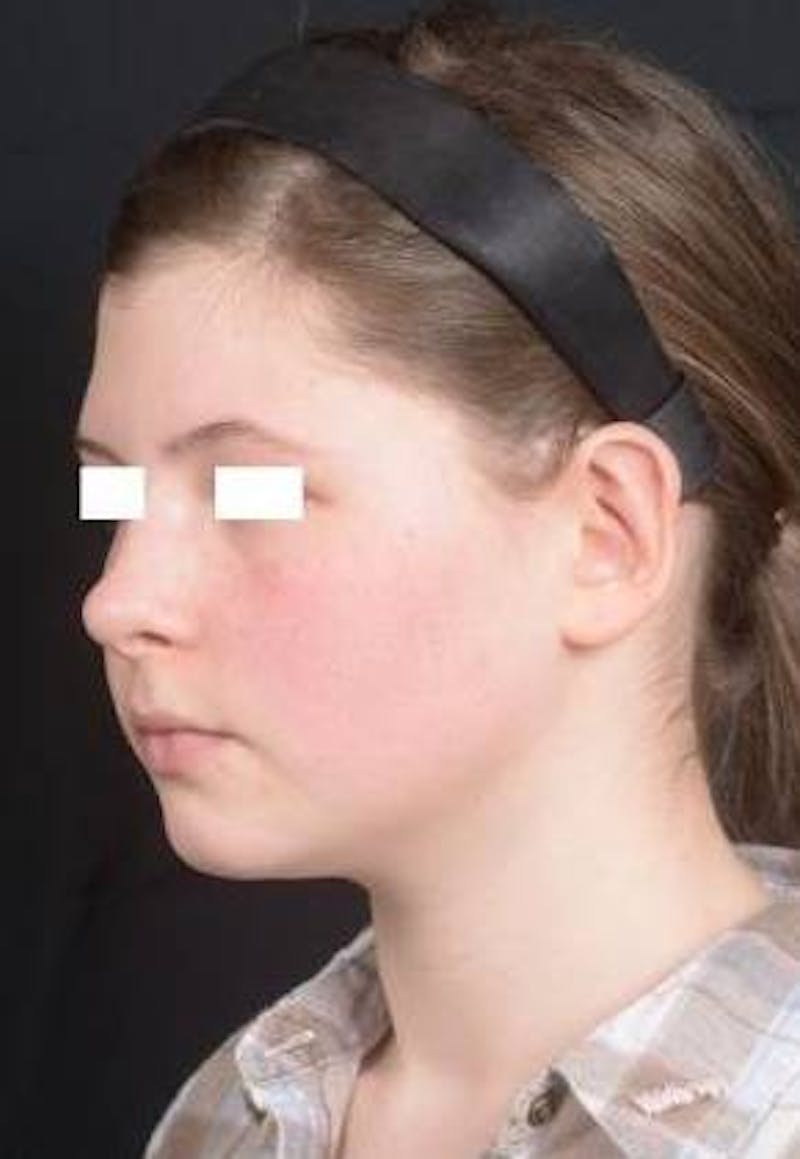 Otoplasty Before & After Gallery - Patient 179716 - Image 6
