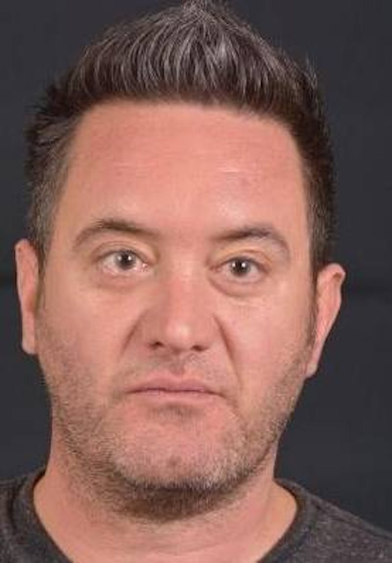 FaceTite Before & After Gallery - Patient 380864 - Image 1