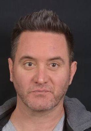 FaceTite Before & After Gallery - Patient 380864 - Image 2