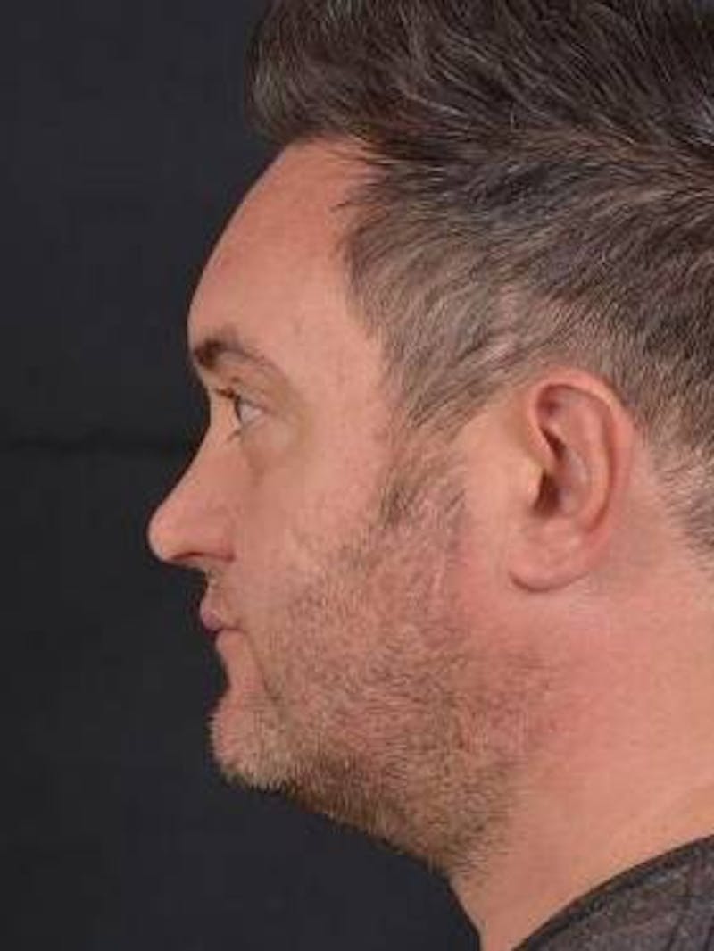 FaceTite Before & After Gallery - Patient 380864 - Image 3