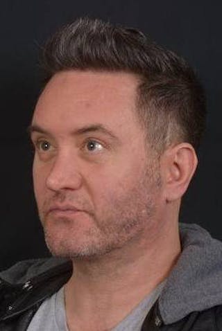 FaceTite Before & After Gallery - Patient 380864 - Image 8